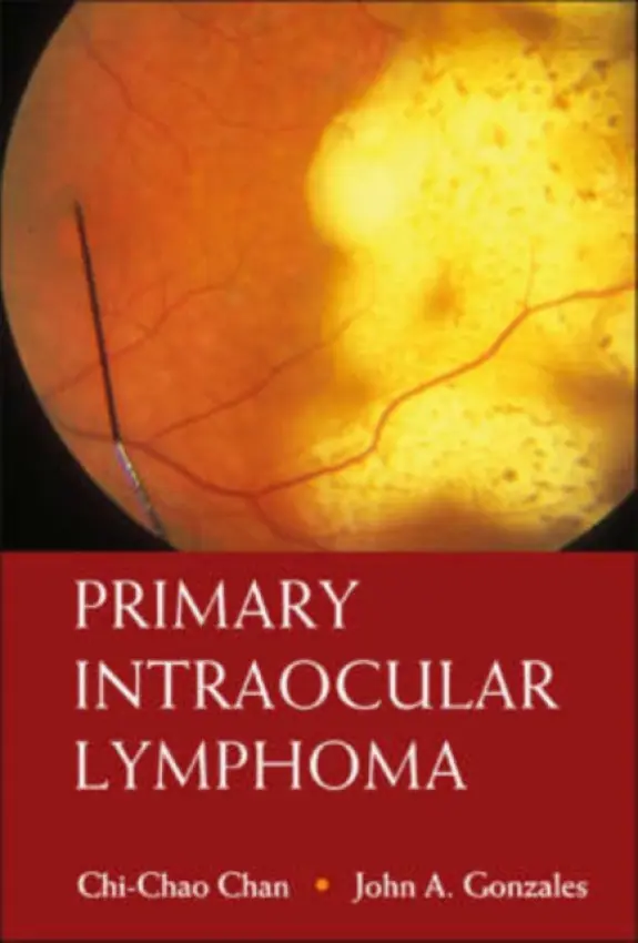 Primary Intraocular Lymphoma - Chan, Chi-chao (Nat'l Eye Inst, Usa) a Gonzales, John A (Univ Of Southern California, Los Angeles, Usa)