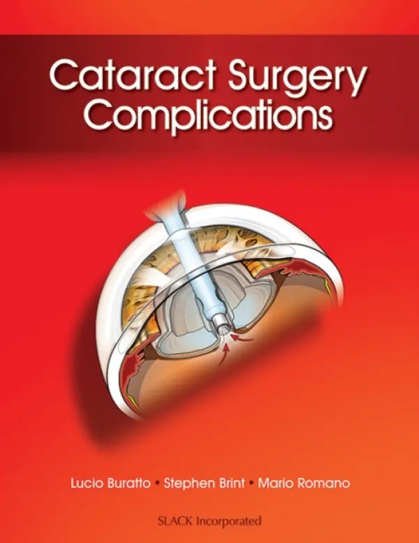 Cataract Surgery Complications - Buratto, Lucio a Brint, Stephen a Romano, Mario