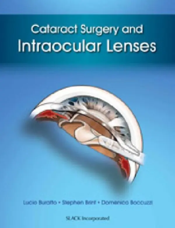 Cataract Surgery and Intraocular Lenses - Buratto, Lucio a Brint, Stephen a Boccuzzi, Domenico