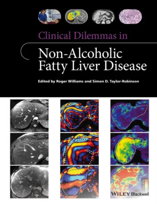 Clinical Dilemmas in Non-Alcoholic Fatty Liver Disease - Williams, Roger a Taylor-Robinson, Simon D.