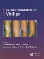 Surgical Management of Vitiligo