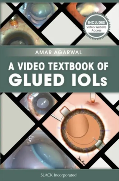 Video Textbook of Glued IOLs - Agarwal, Amar