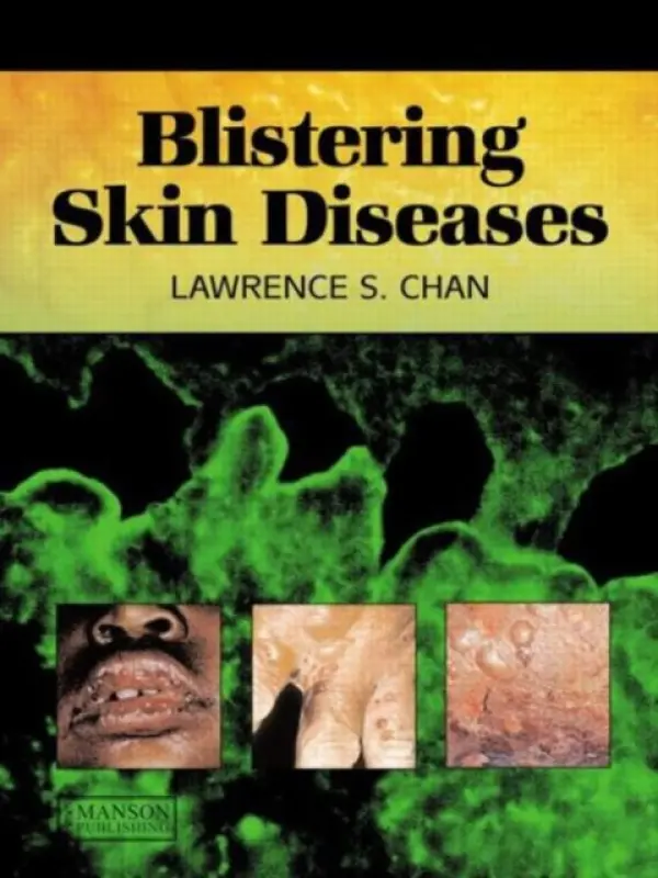 Blistering Skin Diseases - Chan, Lawrence (University of Illinois, Chicago, Illinois, USA)