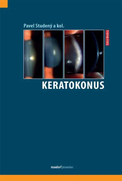 Keratokonus
