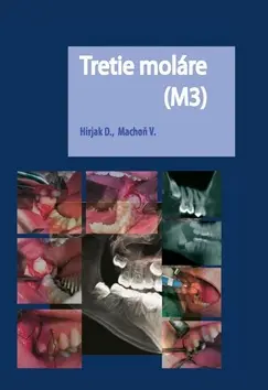 Tretie moláre (M3) - Dušan Hirjak