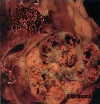 CD Blasted Pancreas: Carcinoma
