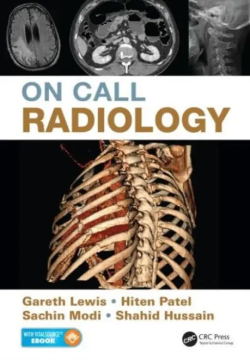 On Call Radiology - Lewis, Gareth (Radiology Registrar, University Hospitals Birmingham NHS Foundation, Edgbaston, Birmingham, UK) a Modi, Sachin (Radiology Registrar, University Hospitals Birmingham NHS Foundation Trust, Edgbaston, Birmingham, UK) a Patel, Hiten (Radiology Regi