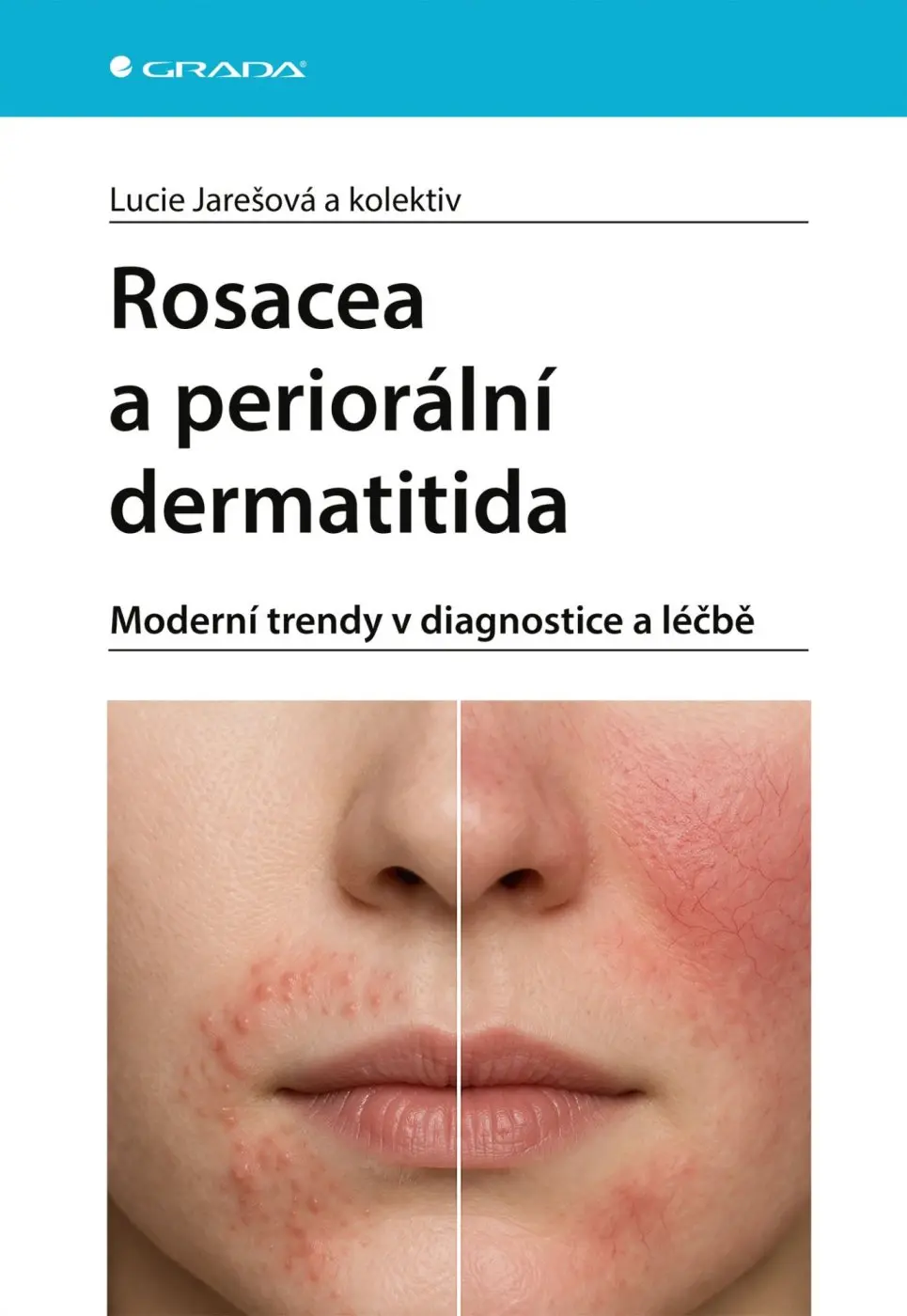 Rosacea a periorální dermatitida - Lucie Jarešová